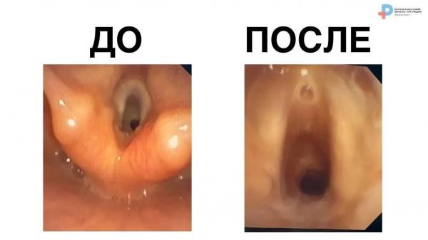 Ребенка со стенозом гортани спасли в медцентре Рошаля